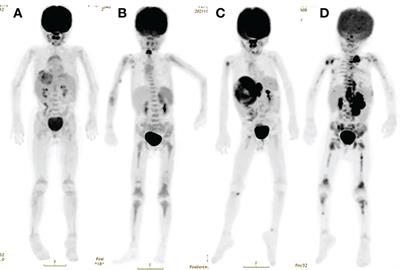 Comparing the diagnostic value of 18F-FDG PET/CT scan and bone marrow biopsy in newly diagnosed pediatric neuroblastoma and ganglioneuroblastoma